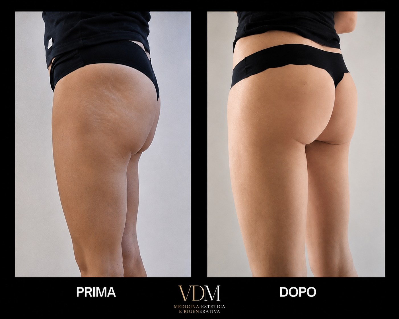 Prima e dopo rimodellamento glutei con acido ialuronico: vista tre quarti con miglioramento della compattezza cutanea e del profilo