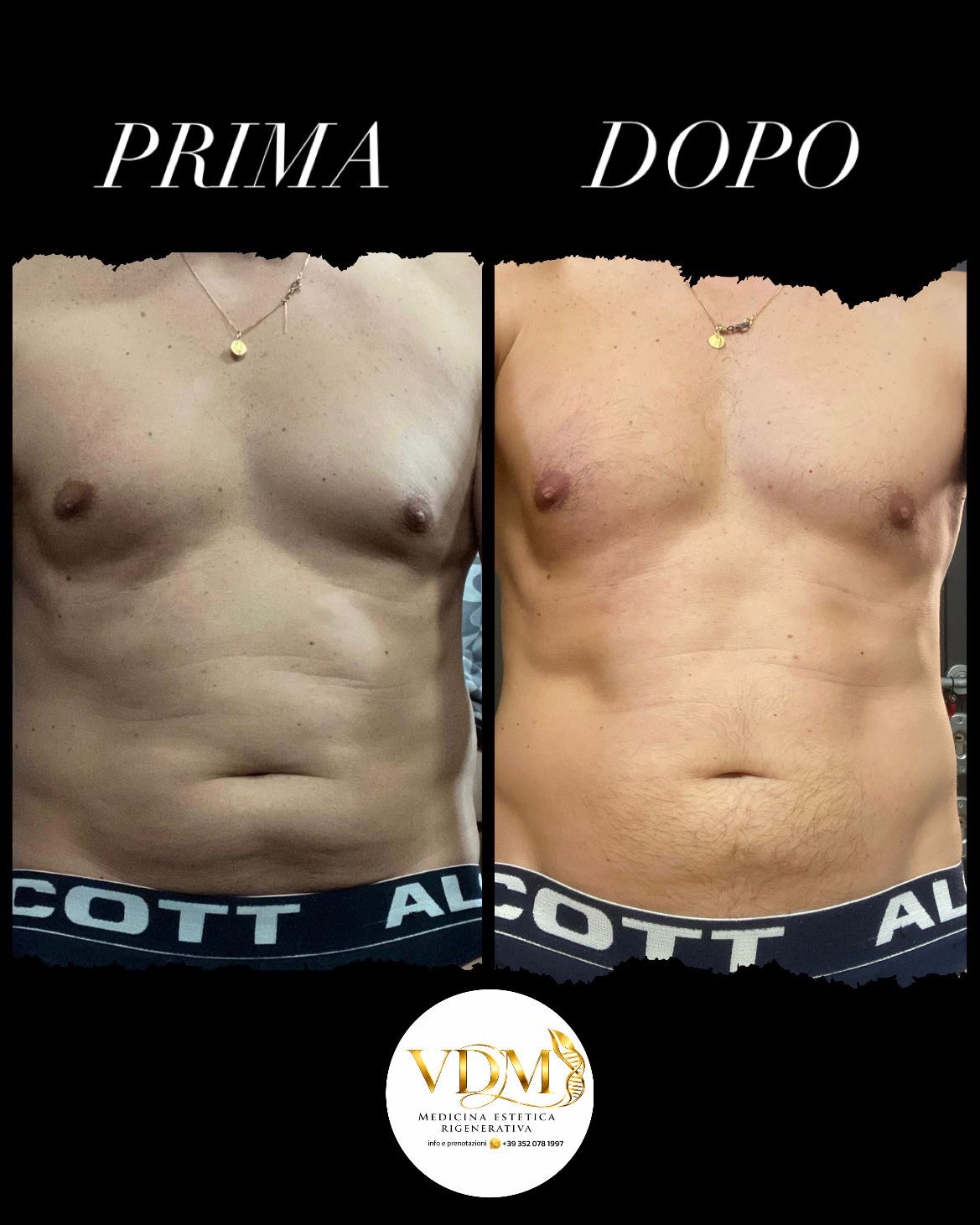 Prima e dopo trattamento Aqualyx: confronto addome e fianchi con riduzione visibile degli accumuli adiposi localizzati e migliore definizione del profilo corporeo