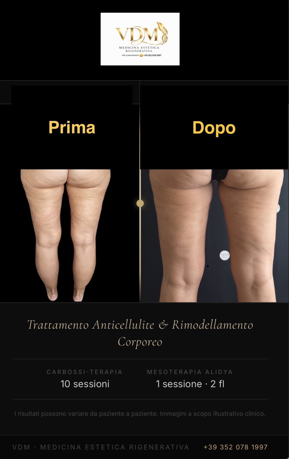 Prima e dopo trattamento anticellulite con carbossiterapia e mesoterapia Alidya: confronto cosce e glutei con riduzione cellulite e miglioramento della compattezza cutanea