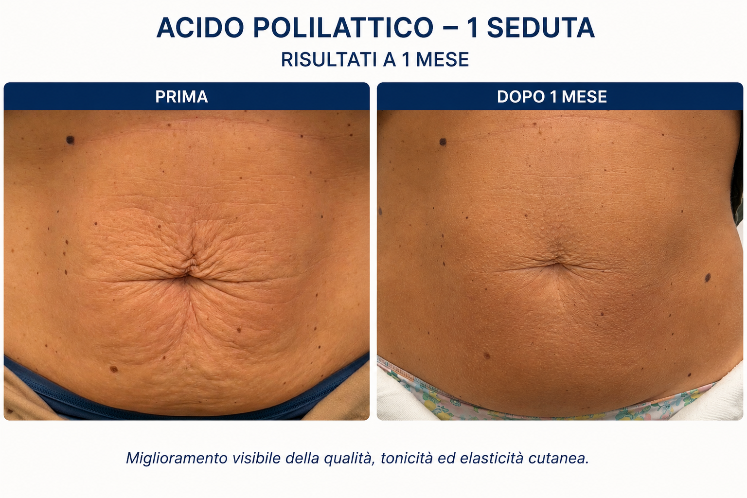Prima e dopo lassità cutanea addome con acido polilattico: confronto addome a 1 mese dalla prima seduta con miglioramento di tonicità ed elasticità cutanea