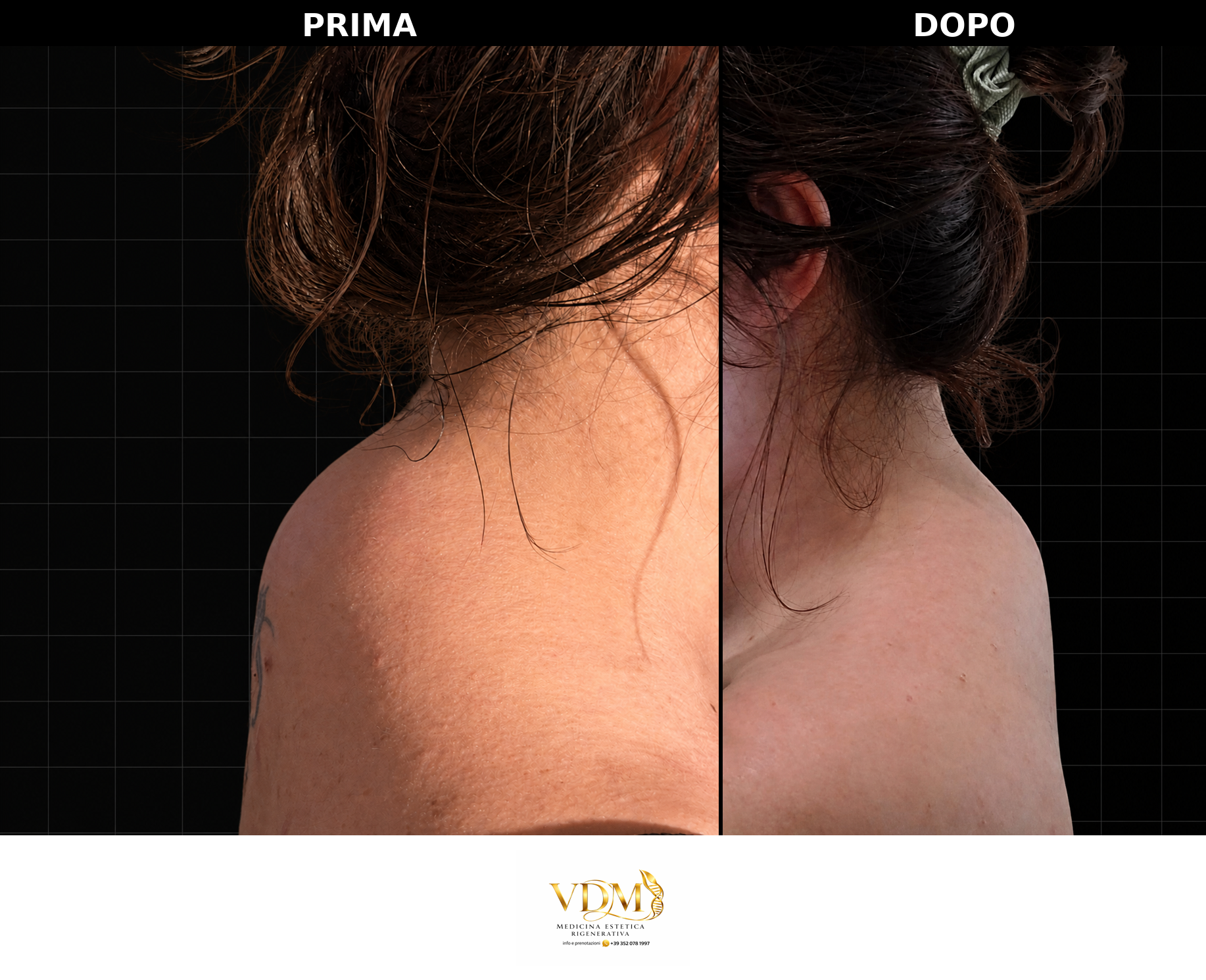 Prima e dopo trattamento lipodistrofia cervico-dorsale: confronto zona nuca con riduzione del cuscinetto adiposo e miglioramento del profilo cervicale