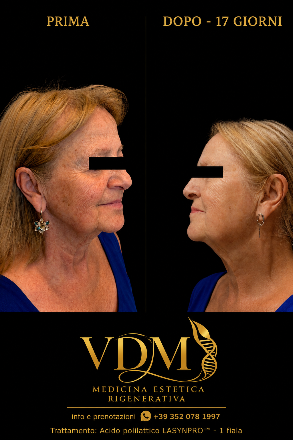 Prima e dopo acido polilattico LASYNPRO: confronto viso donna 73 anni, 1 fiala, a 17 giorni dalla prima seduta di un ciclo di 3 trattamenti