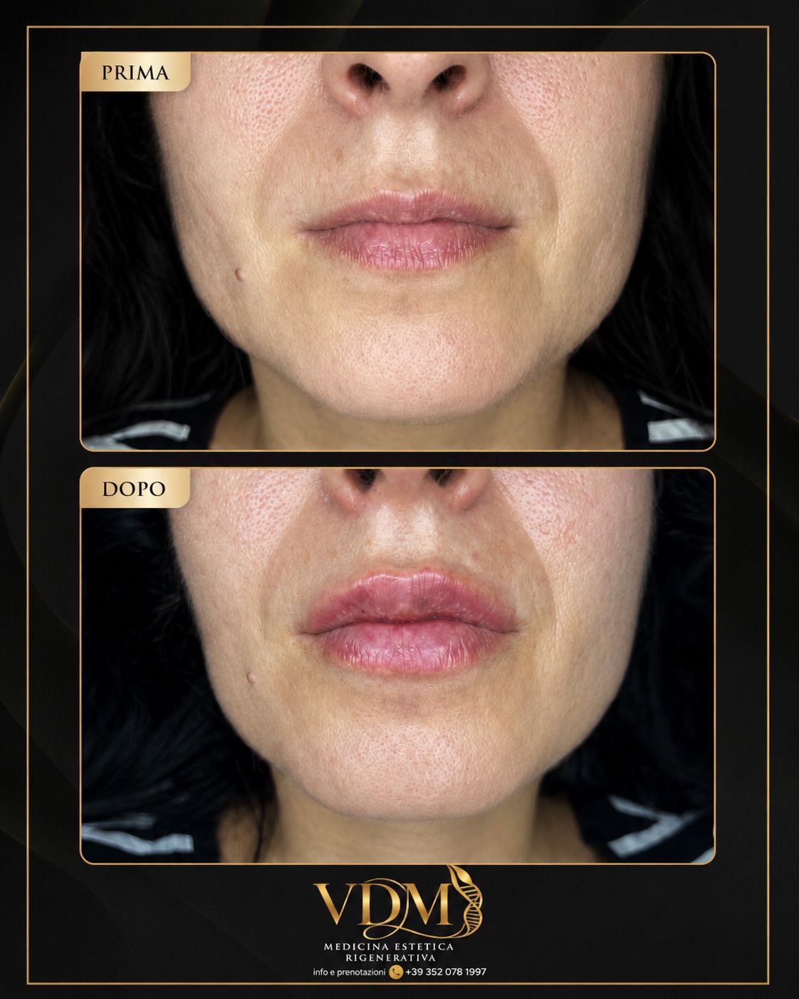 Prima e dopo filler labbra naturale: confronto labbra con volume bilanciato, bordo definito e risultato armonico con acido ialuronico