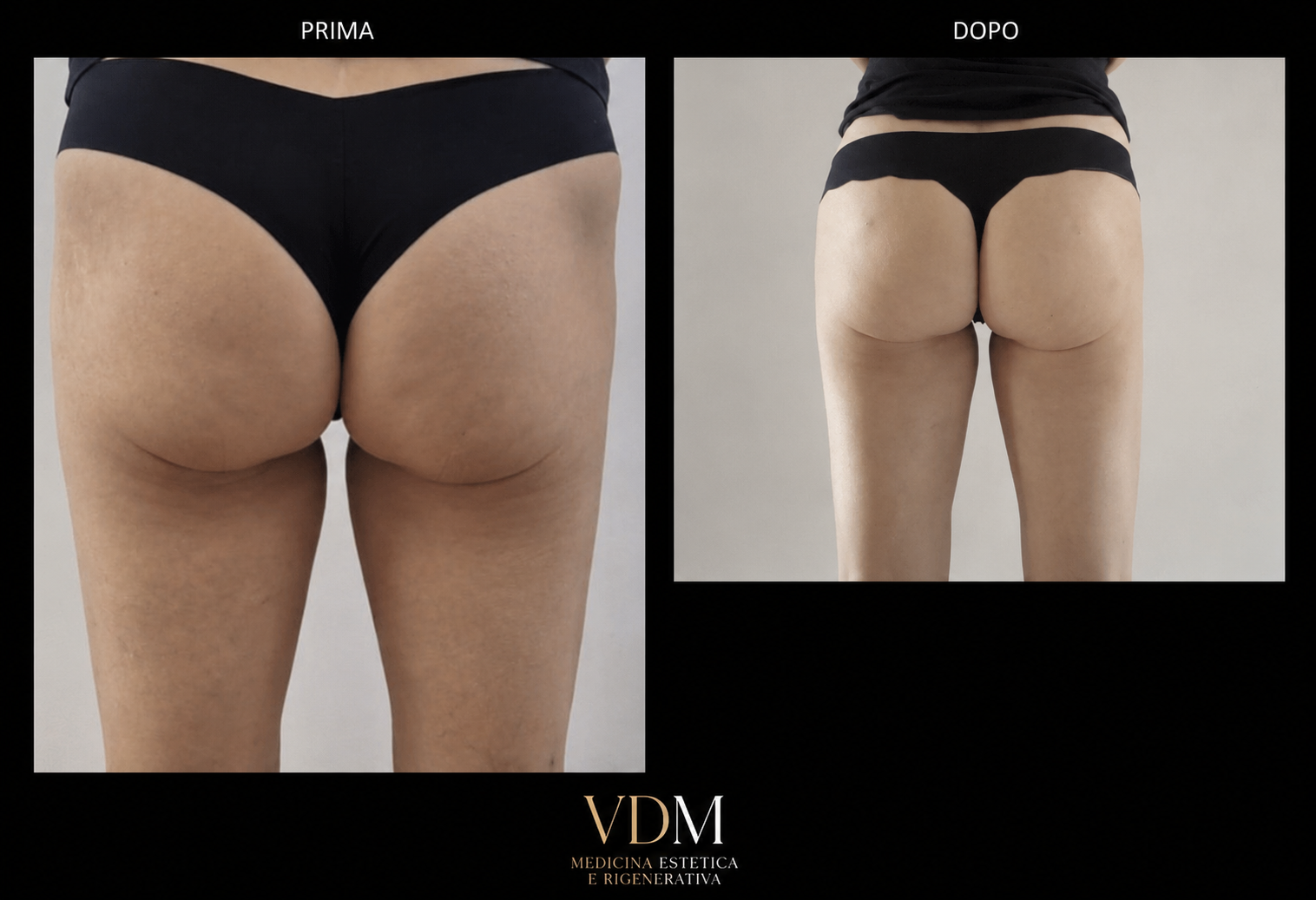 Prima e dopo riempimento glutei con acido ialuronico: vista posteriore con aumento del volume, miglior proiezione e profilo più armonico