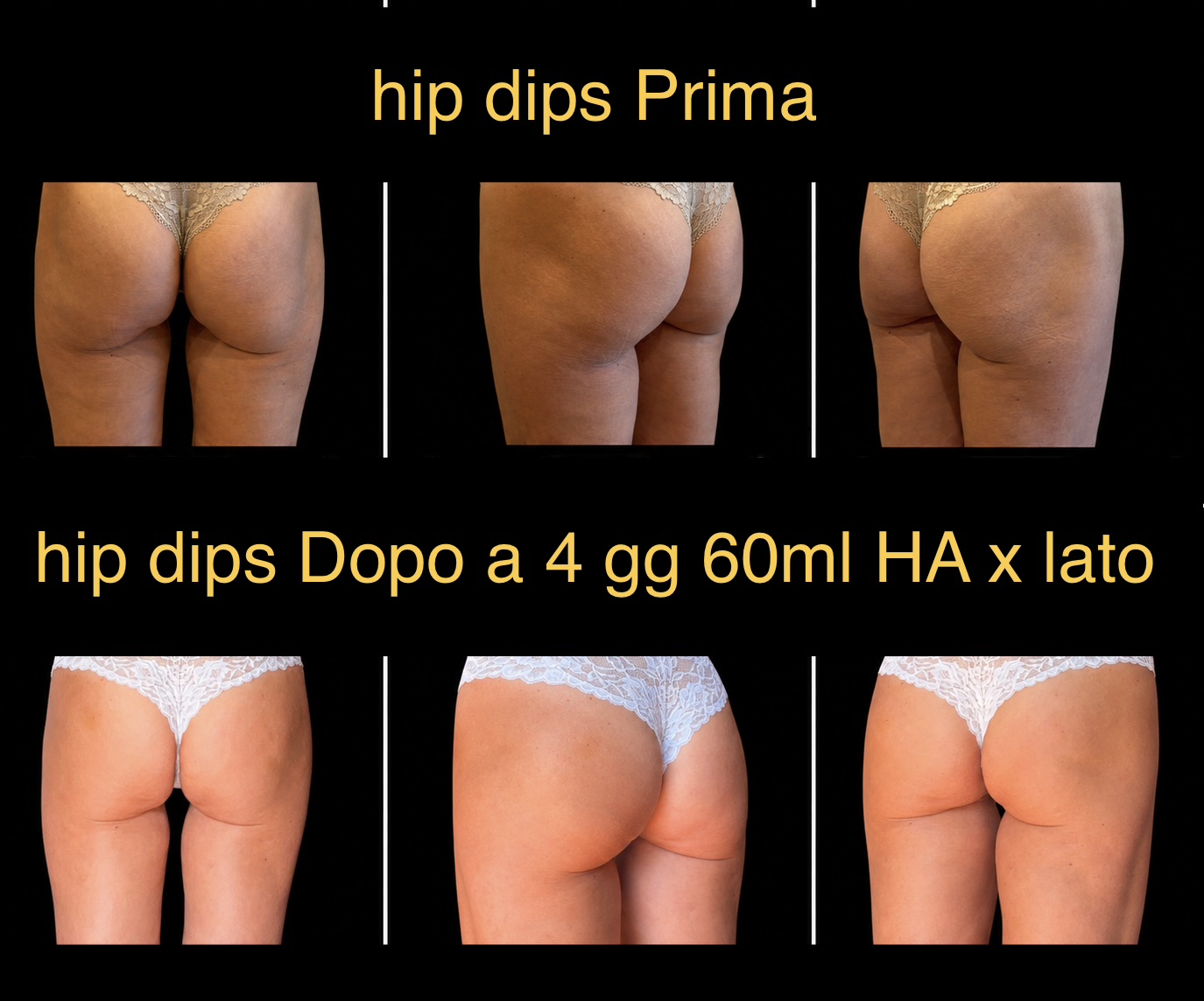 Prima e dopo rimodellamento hip dips con acido ialuronico: confronto fianchi e glutei con 60 ml per lato, risultato a 4 giorni