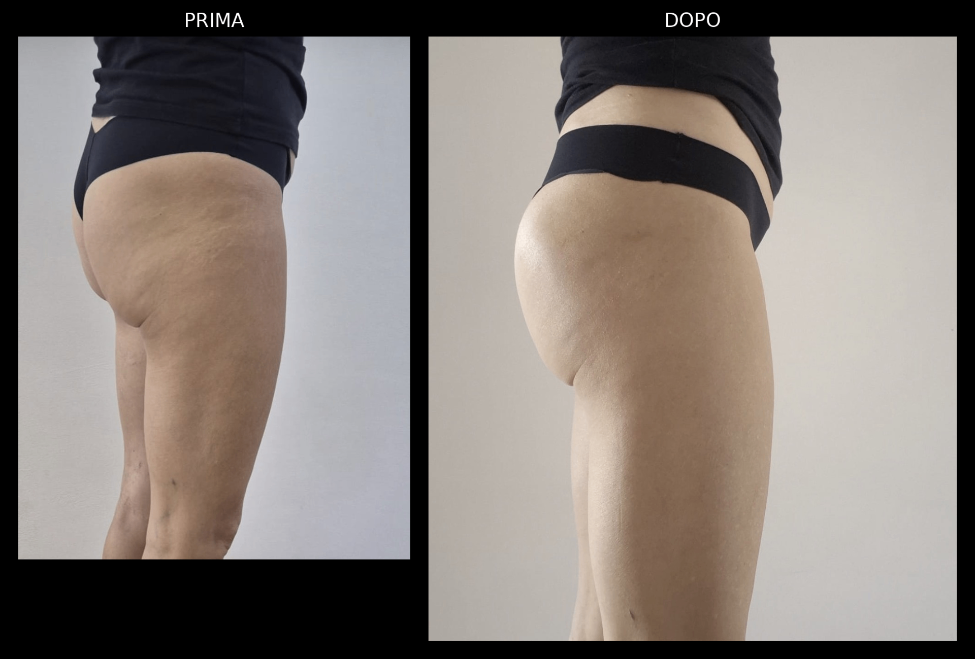Prima e dopo glutei con acido ialuronico: vista laterale con maggior proiezione, profilo più definito e risultato naturale
